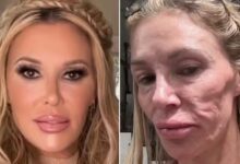 Brandi Glanville vai passar por cirurgia para, nas palavras dela, 'remover o rosto' após relato de pele 'derretida' 12 Brandi Glanville anuncia cirurgia exploratória para 'remover o rosto' após relato de pele 'derretida'