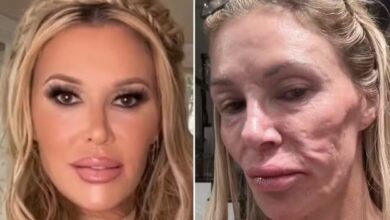 Brandi Glanville vai passar por cirurgia para, nas palavras dela, 'remover o rosto' após relato de pele 'derretida' 2 Brandi Glanville anuncia cirurgia exploratória para 'remover o rosto' após relato de pele 'derretida'