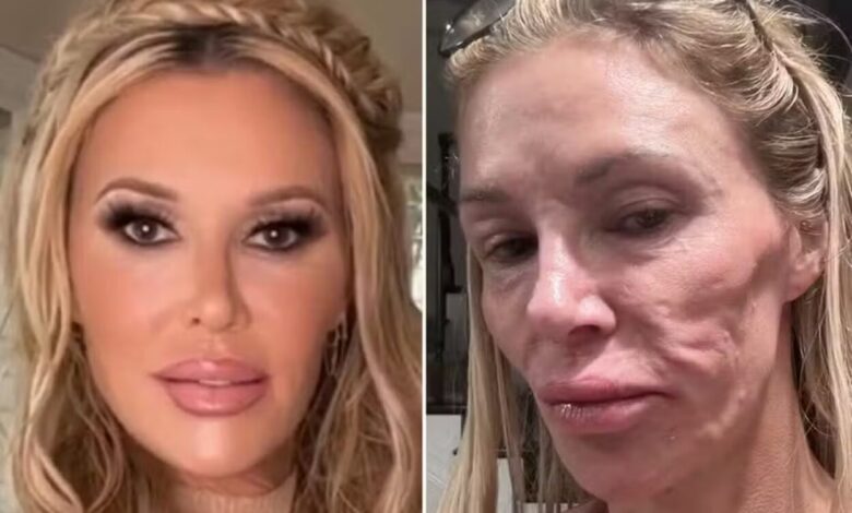 Brandi Glanville anuncia cirurgia exploratória para 'remover o rosto' após relato de pele 'derretida'